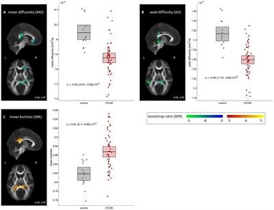 Effects of post-acute COVID-19 syndrome on cerebral white matter and emotional health among non-hospitalized individuals